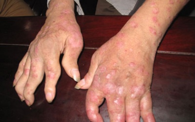 Stress nặng vì vảy nến